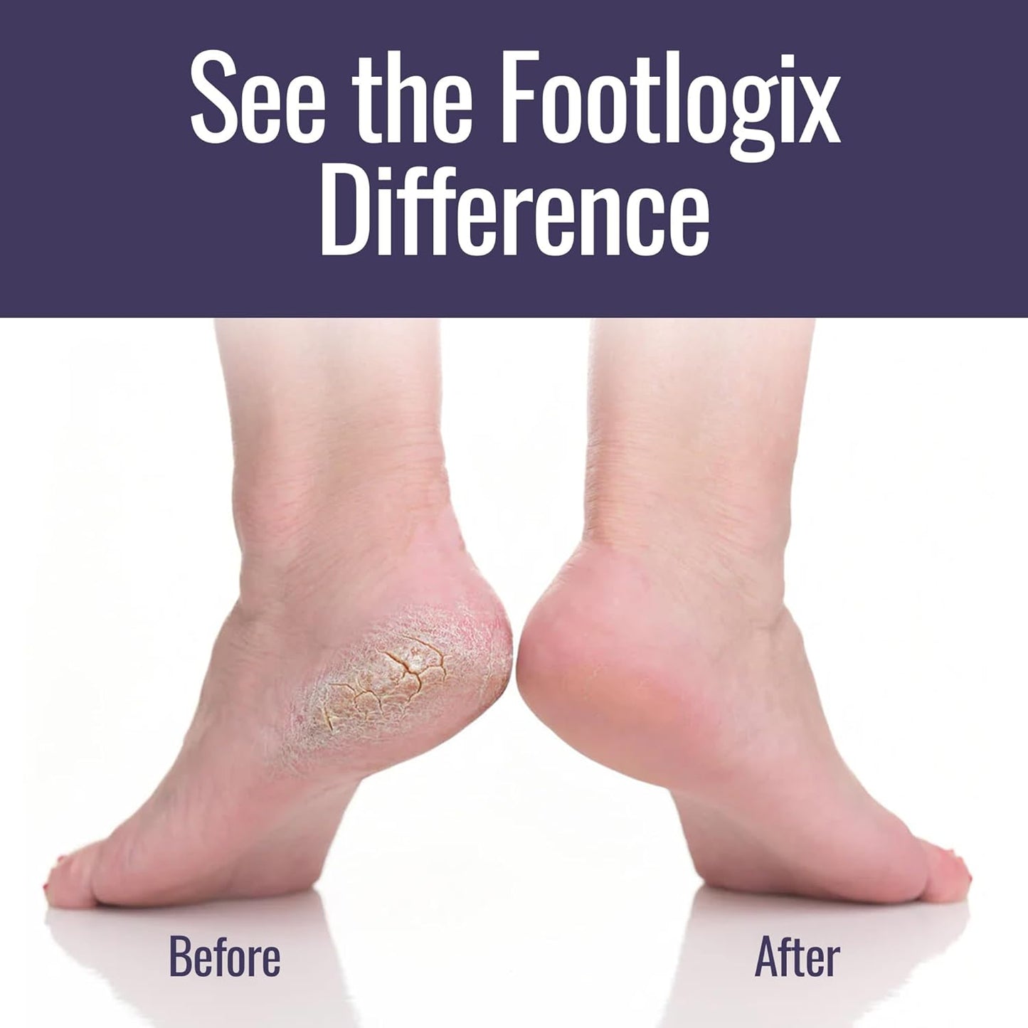 Footlogix - CALLUS SOFTENER MOUSE "AT HOME" COMBO SET 125ml/4.2oz. Please contact us for Professional (Licensed NailTech) pricing!