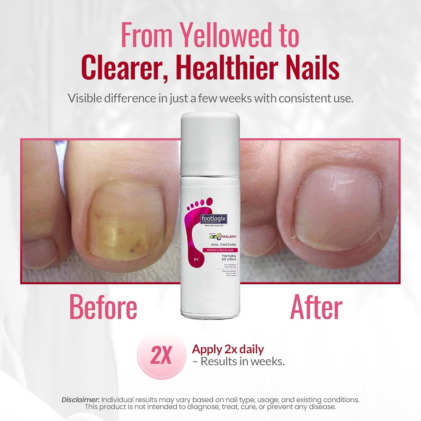 Footlogix - ANTI-FUNGAL TOE TINCTURE SPRAY with SPIRALEEN  44g/1.7oz. Please contact us for Professional (Licensed NailTech) pricing!