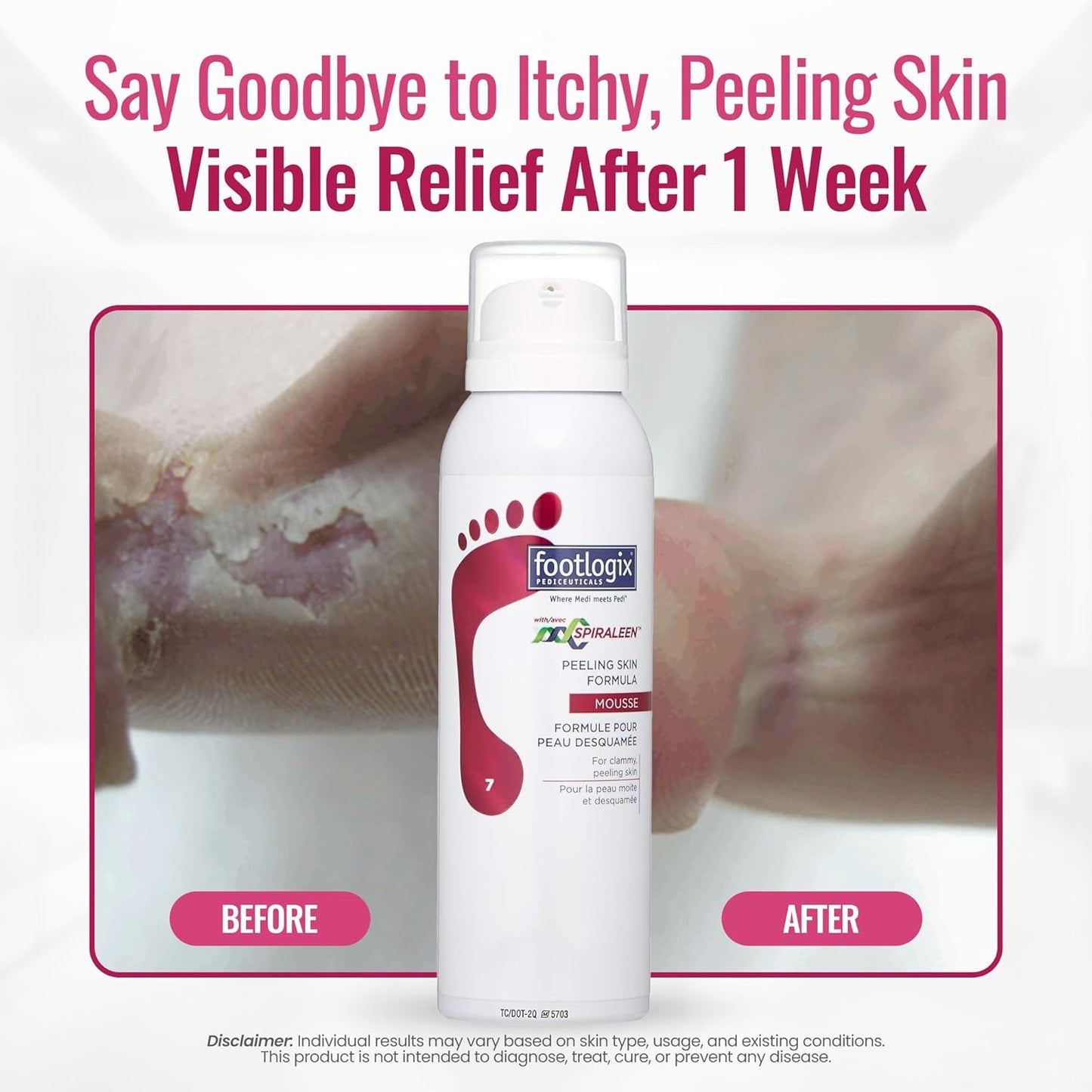 Footlogix - PEELING SKIN FORMULA 120g/4.2oz. Please contact us for Professional (Licensed NailTech) pricing!