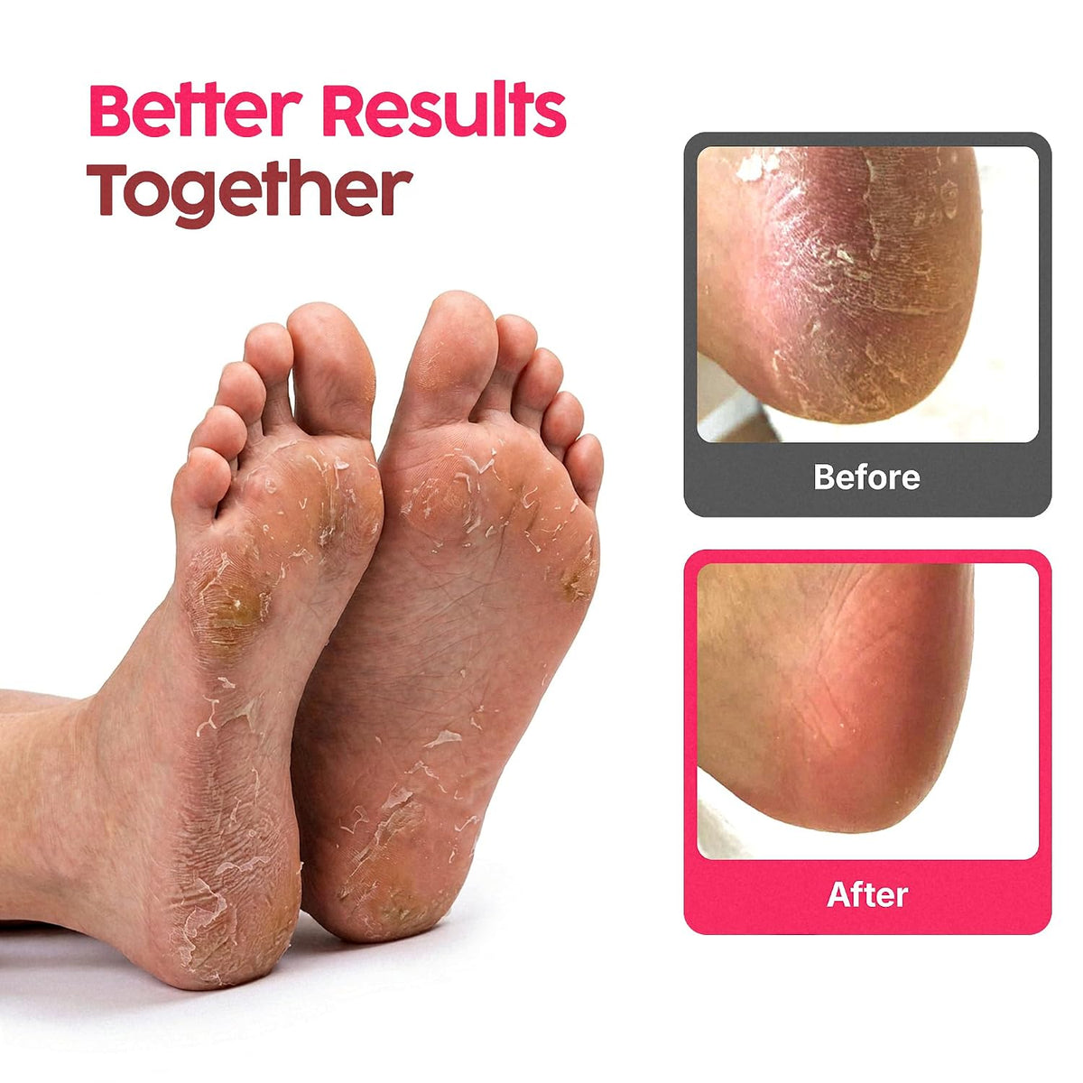 Footlogix - PEELING SKIN FORMULA 120g/4.2oz. Please contact us for Professional (Licensed NailTech) pricing!