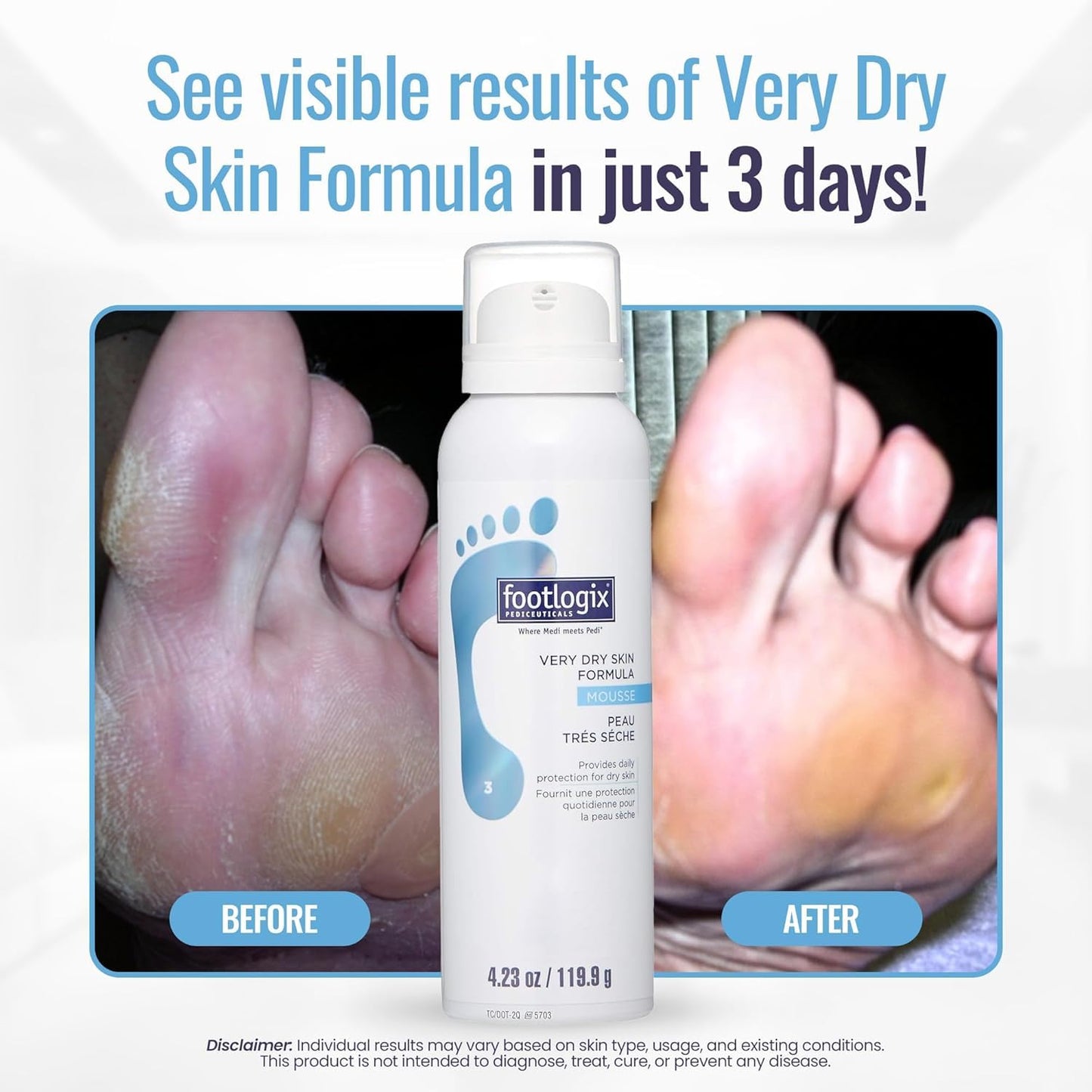 Footlogix - VERY DRY SKIN FORMULA, 125ml or 300ml.