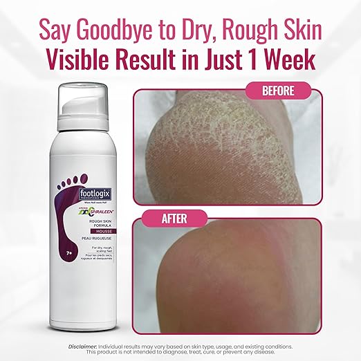 Footlogix - ROUGH SKIN FORMULA 125ml/4.2oz. Please contact us for Professional (Licensed NailTech) pricing!