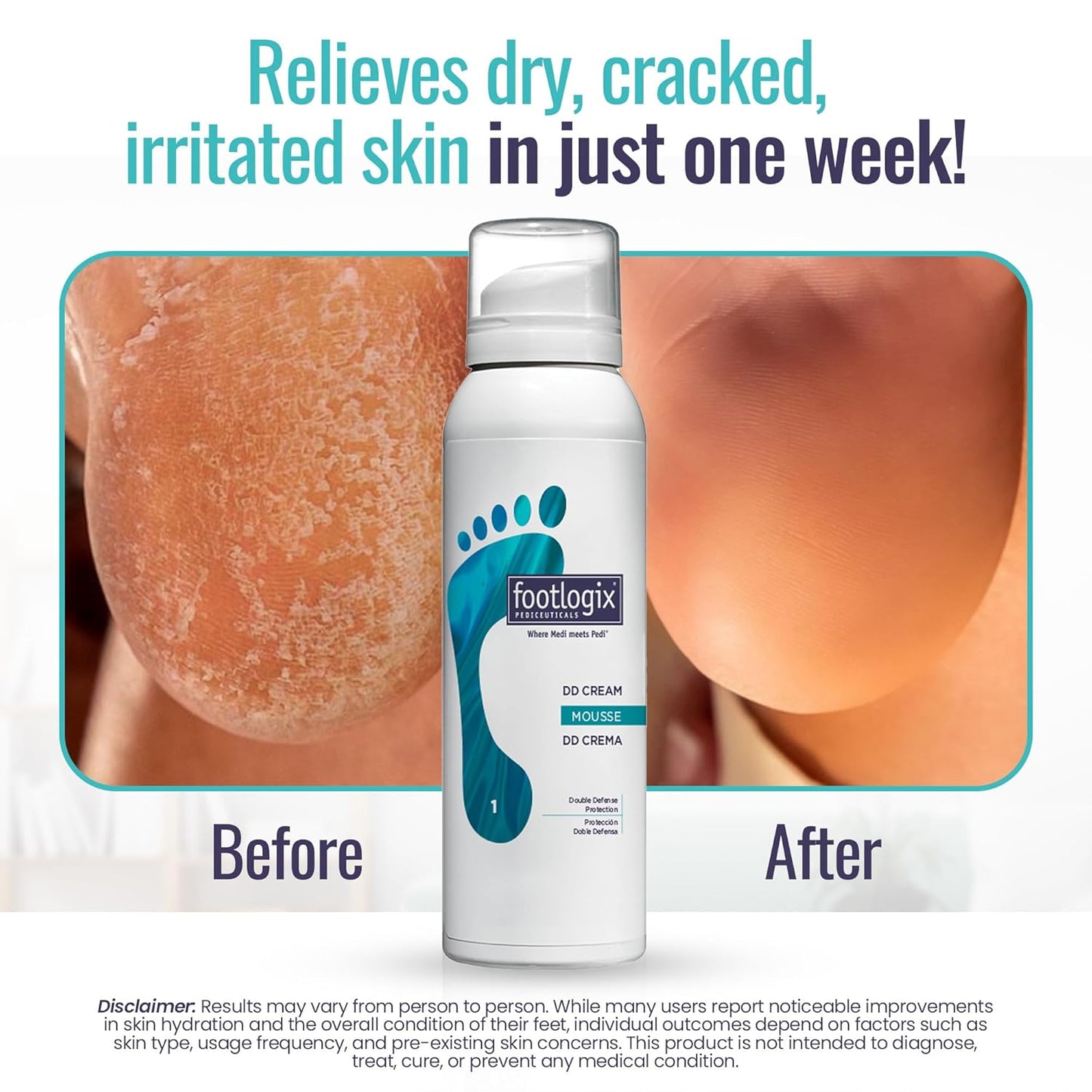 Footlogix - DD CREAM MOUSSE FORMULA 125ml/4.2oz. Please contact us for Professional (Licensed NailTech) pricing!