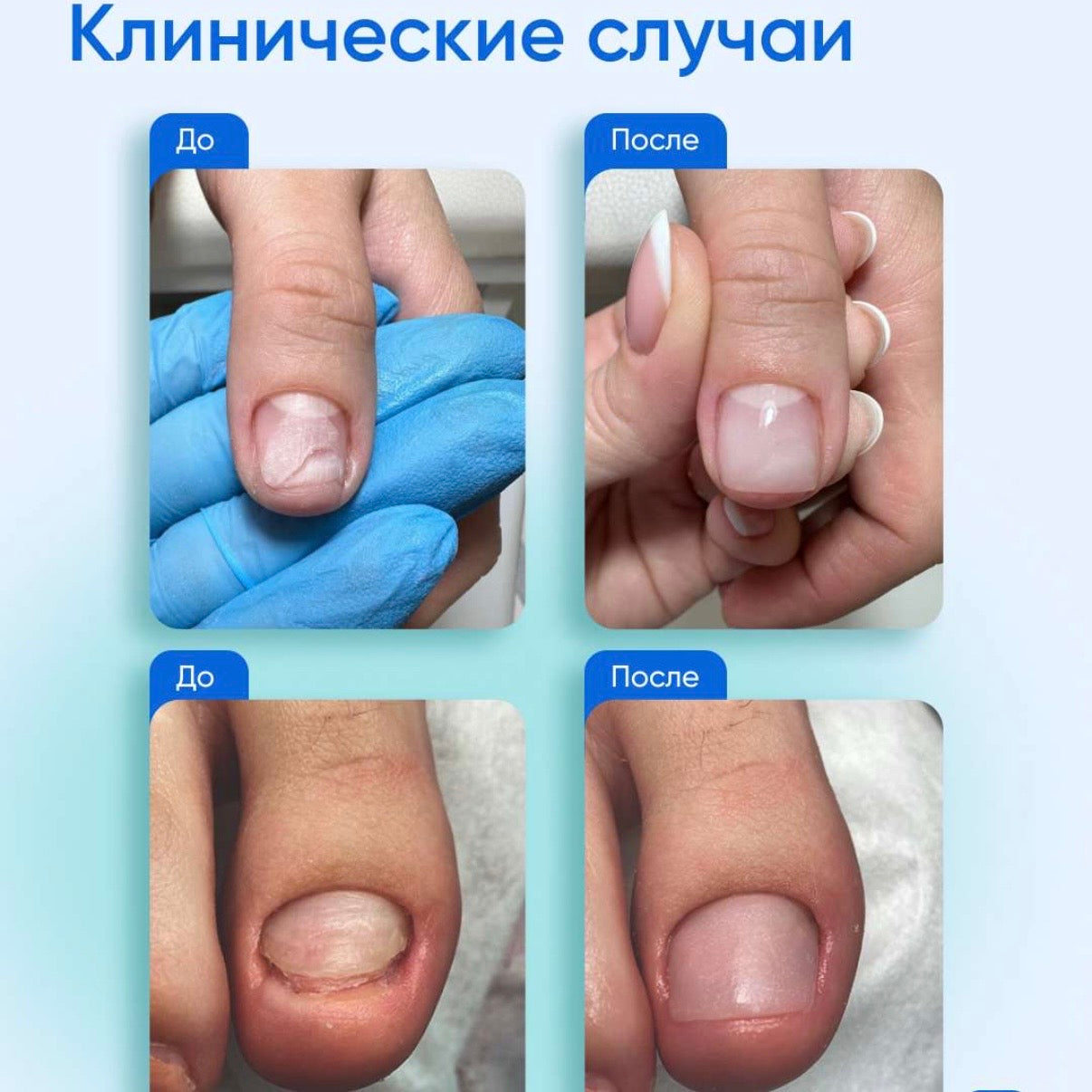 PodolJest Podo Kit for Nail Restoration & Repairs (by Vladmiva)